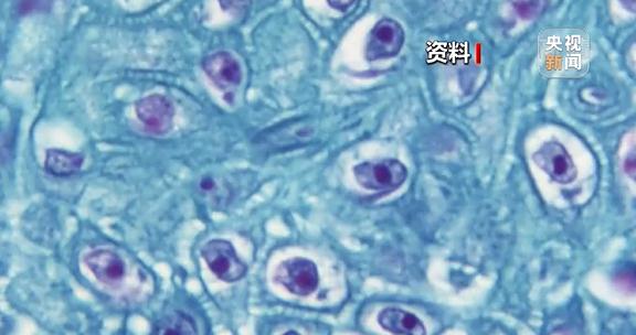 猴痘人际传播途径有哪些？世界多地现病例或进一步传播